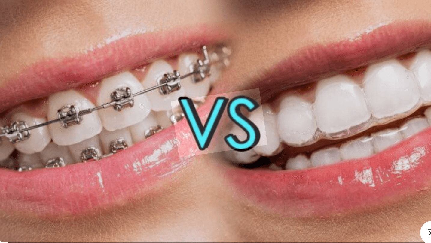 传统牙套 vs 隐适美:哪种矫正方式更适合您?